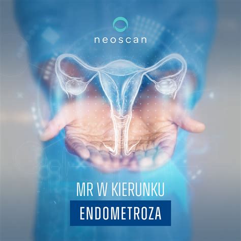 Endometrioza Przyczyny Objawy Diagnostyka I Leczenie Neoscan