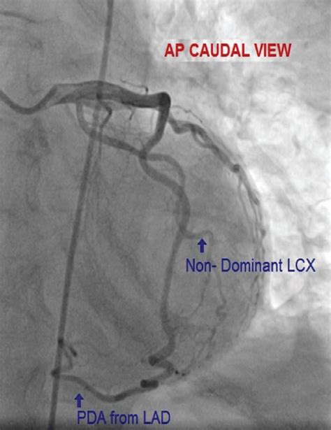 Invasive angiogram showing the circumflex artery and the left anterior ...