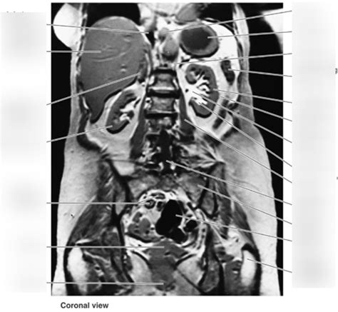 Coronal Mri Of Abdomen Diagram Quizlet