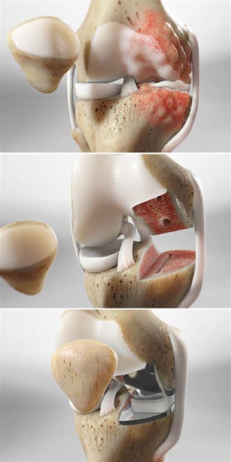 New Partial Knee Replacement