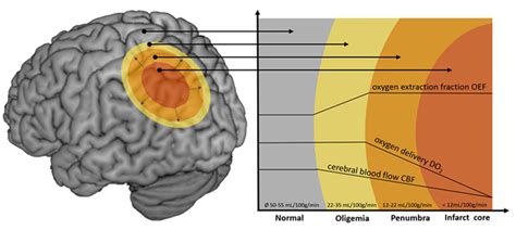 Illustration Of The Penumbra Concept Infarct Core Red Infarcted