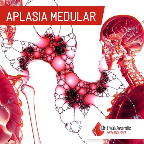 Aplasia Medular É Câncer - La aplasia medular es... - Dr. Paúl Jaramillo T. - Hematólogo | Facebook