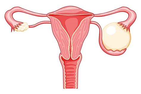 Les kystes ovariens sont bénins et sur un ovaire