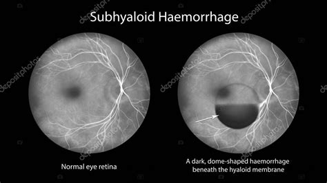 Una Hemorragia Subhialoide En La Retina Como Se Observ Durante La