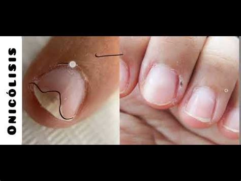 Onicólisis en uñas de las manos #nails #uñas #enfermedades - YouTube