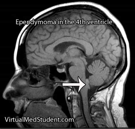 VirtualMedStudent.com || Ependymoma