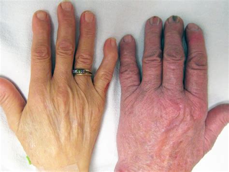 Anemia Hands