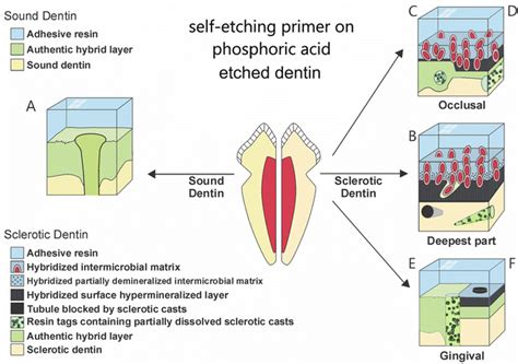 cervical sclerotic dentin resin bonding pocket dentistry