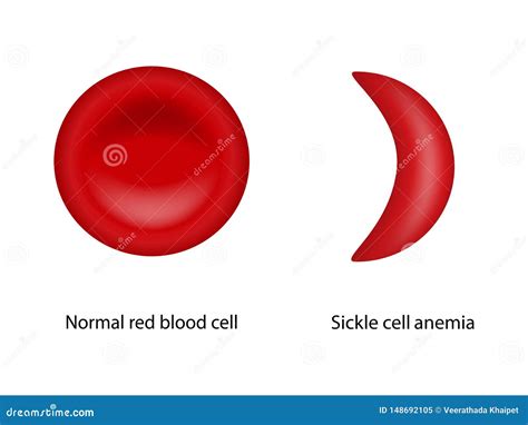 Normal Red Blood Cell And Sickle Cell Anemia Stock Vector