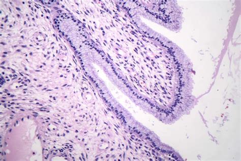 Histopathology Of Nasal Polyps Stock Image Image Of Cell Micro