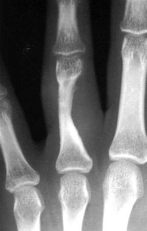 Epithelioid Sarcoma - Pathology - Orthobullets