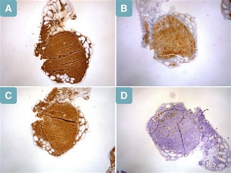 A Ileum Follicular Lymphoma Duodenal Type Cd20 Immunostaining 100x Download Scientific