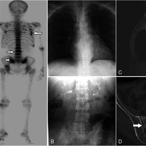 A Whole Body Bone Scintigraphy Showed Multiple Foci Of Increased