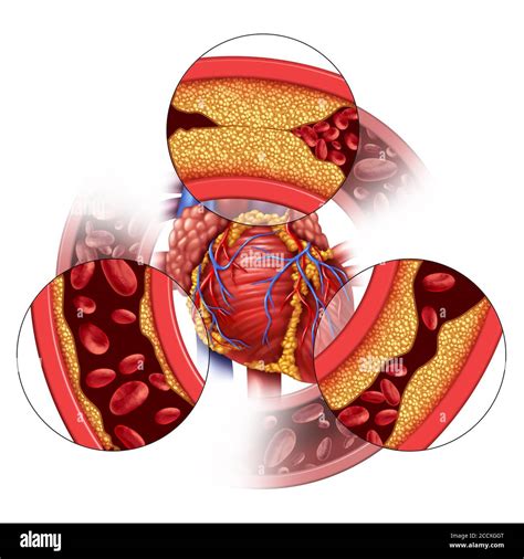 Heart Blockage Hi Res Stock Photography And Images Alamy