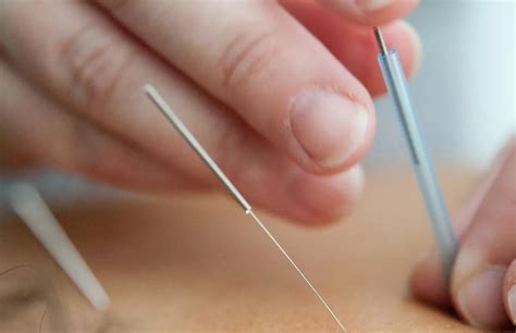 Ultrasound Guided Dry Needling Ashirvad