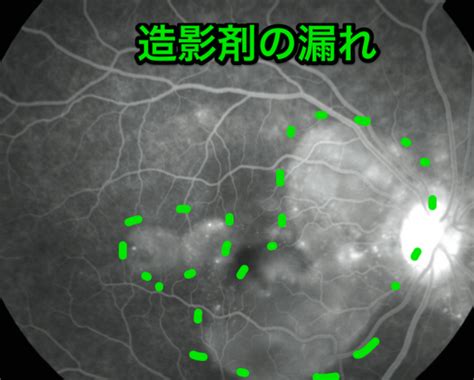 【眼科1】視力検査の読み方と度数の合わせ方 〜近視、遠視〜 コウメイ塾