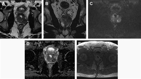 Infectious And Inflammatory Diseases Of The Urinary Tract Radiology Key