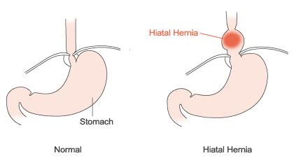 Hiatus Hernia Info: Hiatus Hernia Reflux Signs or symptoms