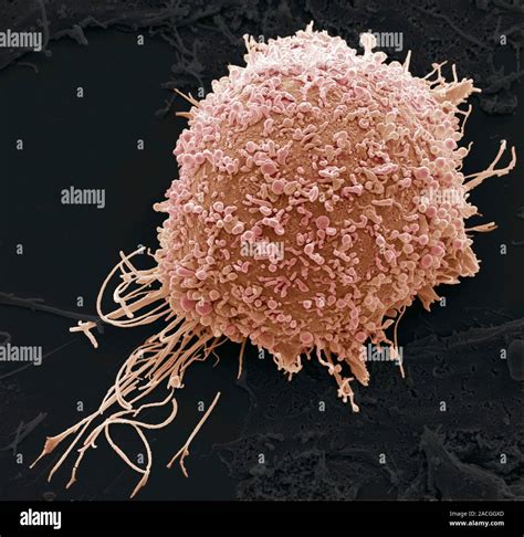 Cervical Cancer Cell Coloured Scanning Electron Micrograph Sem