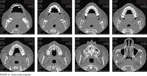 Scielo Brasil Tomografia Computadorizada De Feixe C Nico Cone Beam