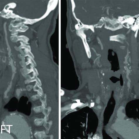 Preoperative Computed Tomography Angiogram Demonstrating Severe Download Scientific Diagram