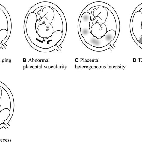 A 33 Year Old Woman With Placenta Previa And Placenta Percreta Download Scientific Diagram