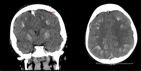 CT-scan showing calcifications in the cerebral falx, tentorium... | Download Scientific Diagram