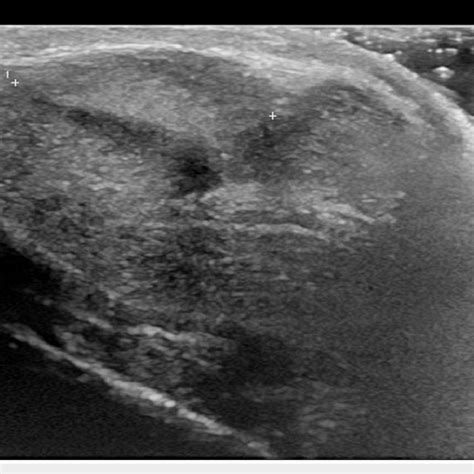 Ultrasound Demonstrating A 1 67 Cm Slightly Hyperechoic Soft Tissue