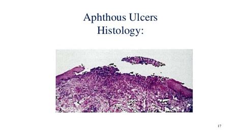 Aphthous Ulcer Histology