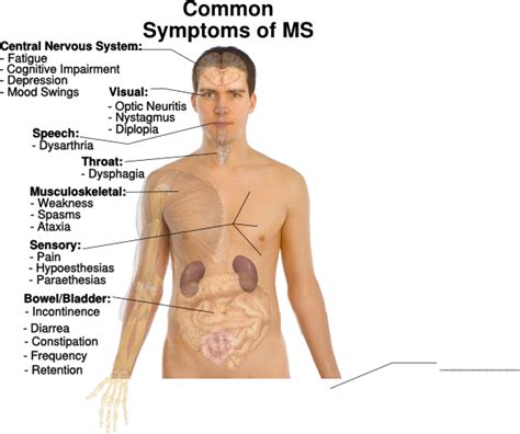 Common Symptoms Of Ms Clip Art at Clker.com - vector clip art online ...