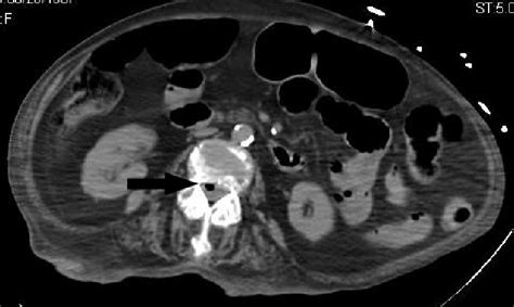 Computed Tomography Axial Image Of The Abdomen Demonstrating Gas In The