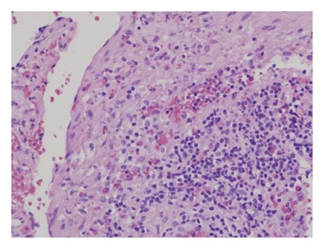 Histopathology From Brain Biopsy Revealing Eosinophilic Infiltration In Download Scientific