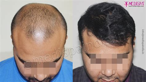 How To Choose The Hair Transplant Clinic Hair Transplant Surgery