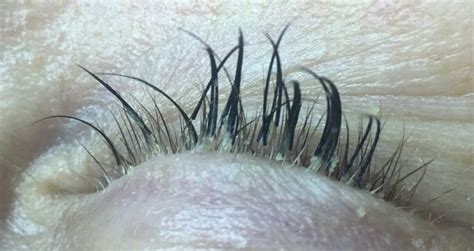 Eyelash Mites: The Truth About Eyelash Extension