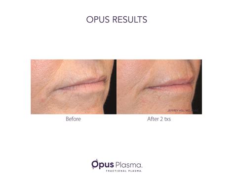 Facial Skin Resurfacing Opus Plasma