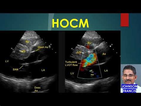 Hocm Hypertrophic Obstructive Cardiomyopathy Youtube