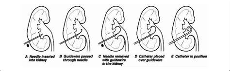 Percutaneous Nephrostomy