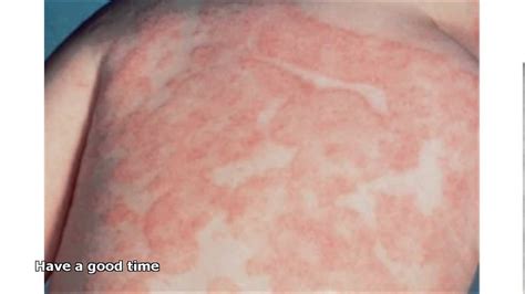 Fungal Skin Infections Pictures Youtube