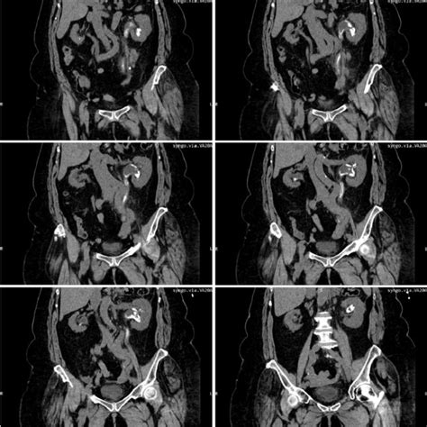 Multiplanar Reconstruction Of Abdominal And Pelvic Ct Scans Without Download Scientific Diagram