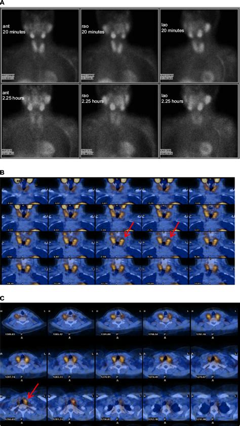 Interpretation Of Tc 99m Sestamibi Parathyroid SPECT CT Scans Made Eas