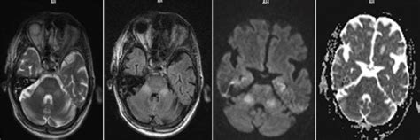 Hyperintensities On Mr Images T2 And Flair In Middle Cerebellar Download Scientific Diagram