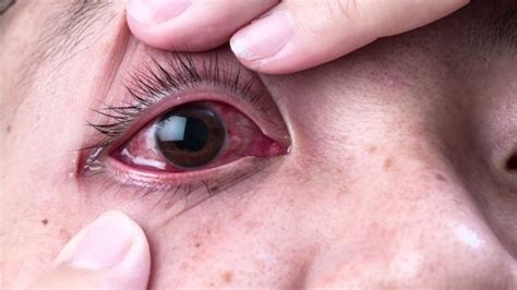 Kinds of eye infections symptoms complications and ways to prevent them