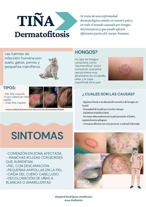 TiÑa Dermatofitosis Resumen De Tiña Piel Tiña Corporis Cuero Cabelludo Tiña Capitis Uñas