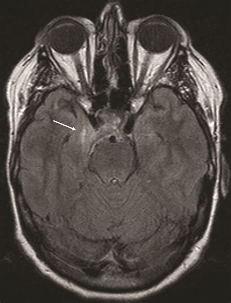 Dural Arteriovenous Fistula | Applied Radiology