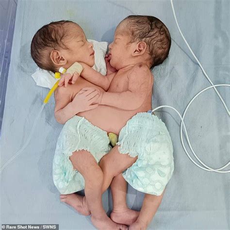 A Mum Has Given Birth To Two Conjoined Boys In India Who Doctors Say Are Healthy Despite