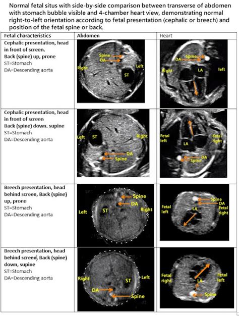 Bushra's Ultrasound Blog: Normal Situs With Different Fetal Positions