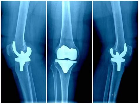 Orthopedic Joints Reconstruction Uteshiya Medicare