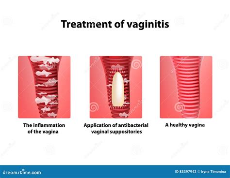 Treatment Of Vaginitis Suppositories. Inflammation The Vagina ...