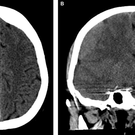 A Pre Operative Axial Non Contrast Ct Soft Tissue Window