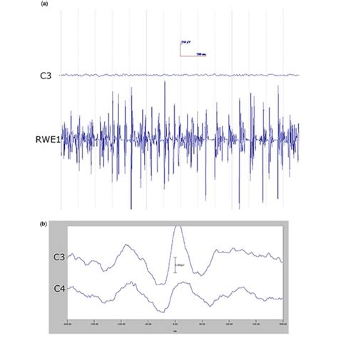 Cortical Myoclonus A Multiple Brief Myoclonus Electromyographic Emg Download Scientific